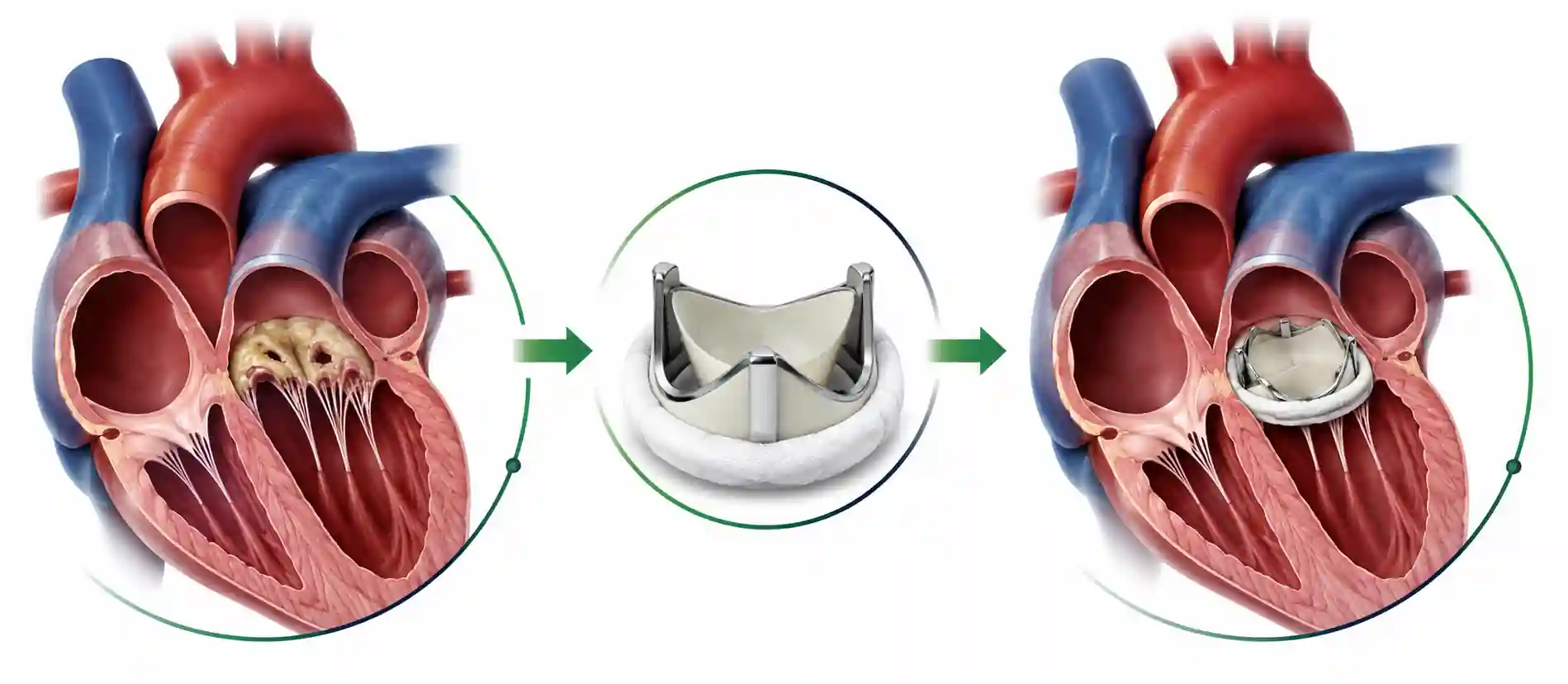 Heart valve replacement surgery illustration showing damaged valve and new prosthetic valve