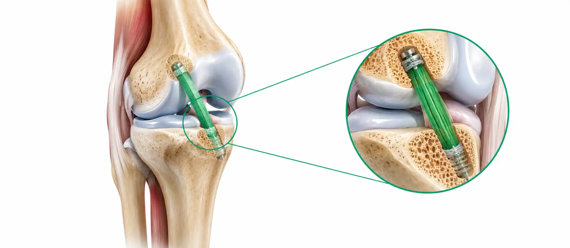 ACL reconstruction cost in India illustration showing arthroscopic graft placement in the knee joint