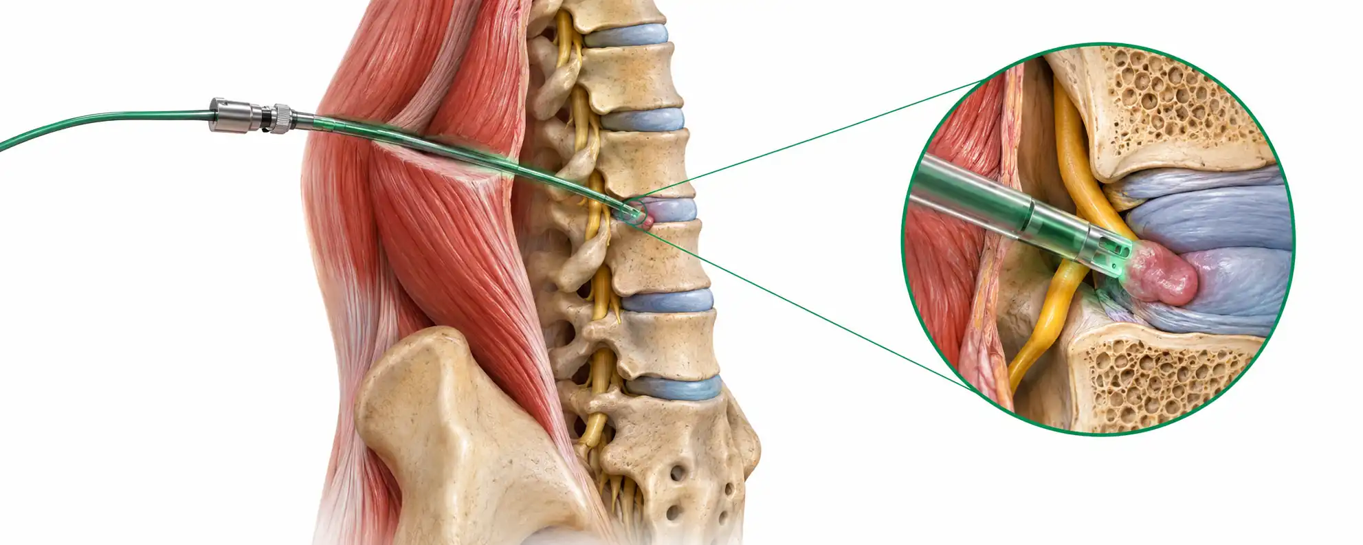 Endoscopic spine surgery cost in India illustration showing a micro-endoscope accessing a herniated disc