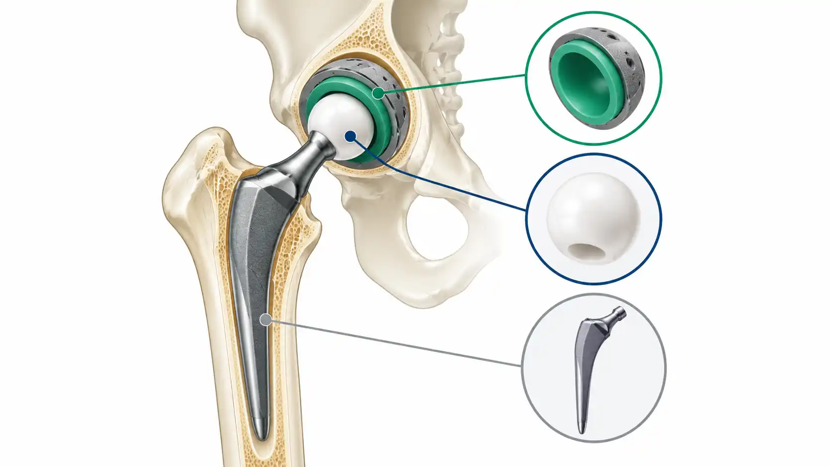 Diagram of a prosthetic hip implant replacing a damaged ball-and-socket joint