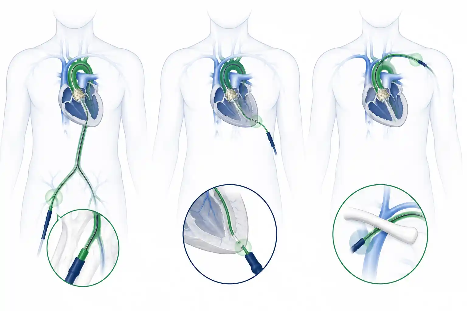 Comparison of TAVR access routes: transfemoral, transapical, and subclavian
