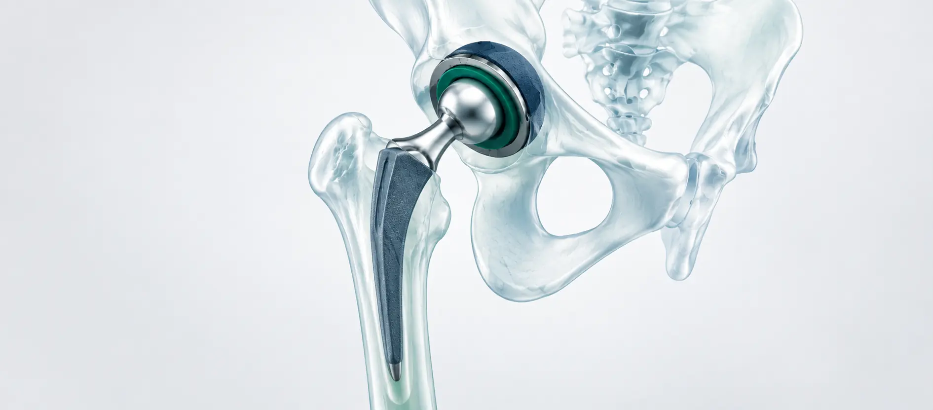 Total hip replacement cost in India illustrated with a prosthetic hip implant